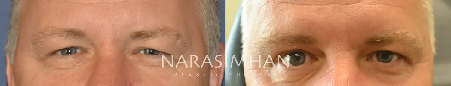 Blepharoplasty Before & After