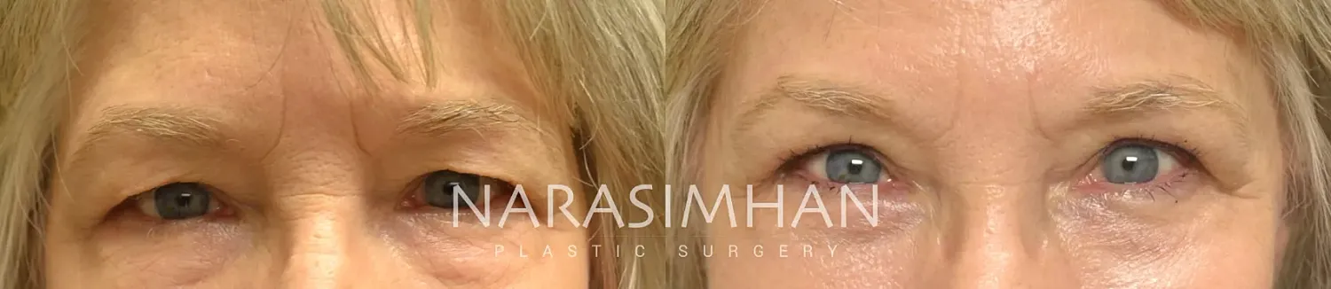 Blepharoplasty Before & After
