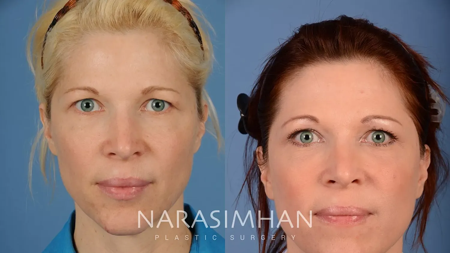 Blepharoplasty Before & After