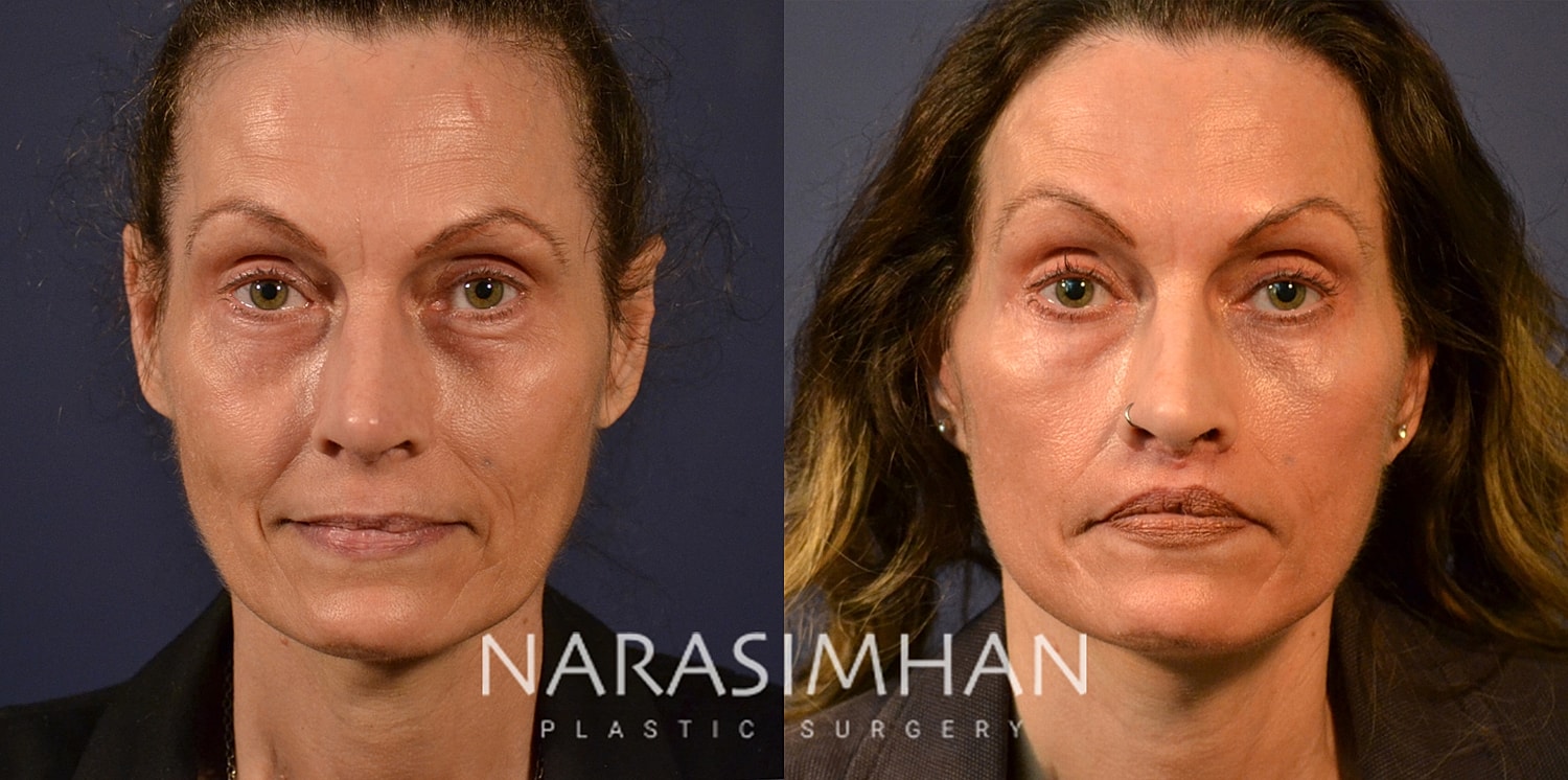 Blepharoplasty Before & After