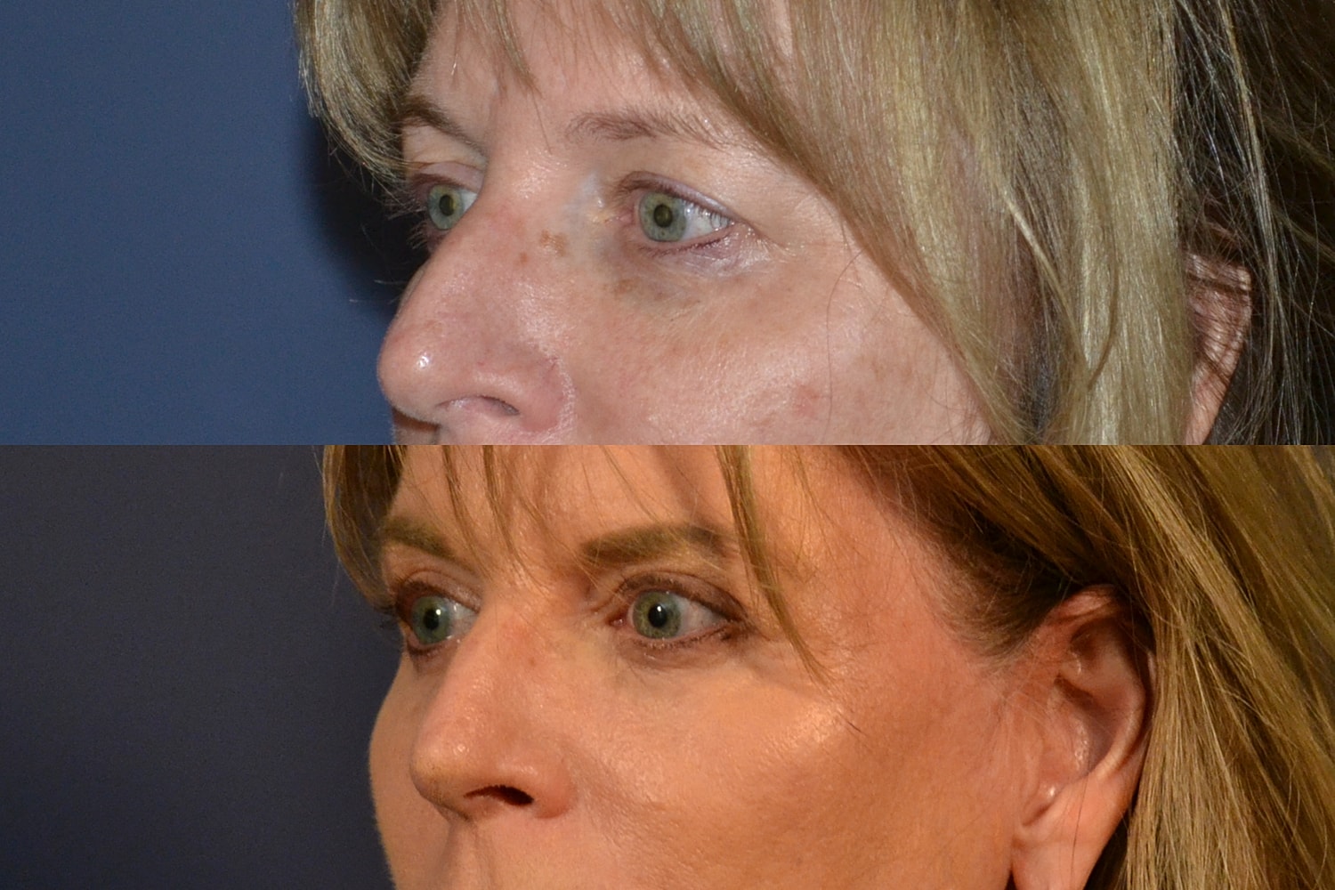 Blepharoplasty Before & After