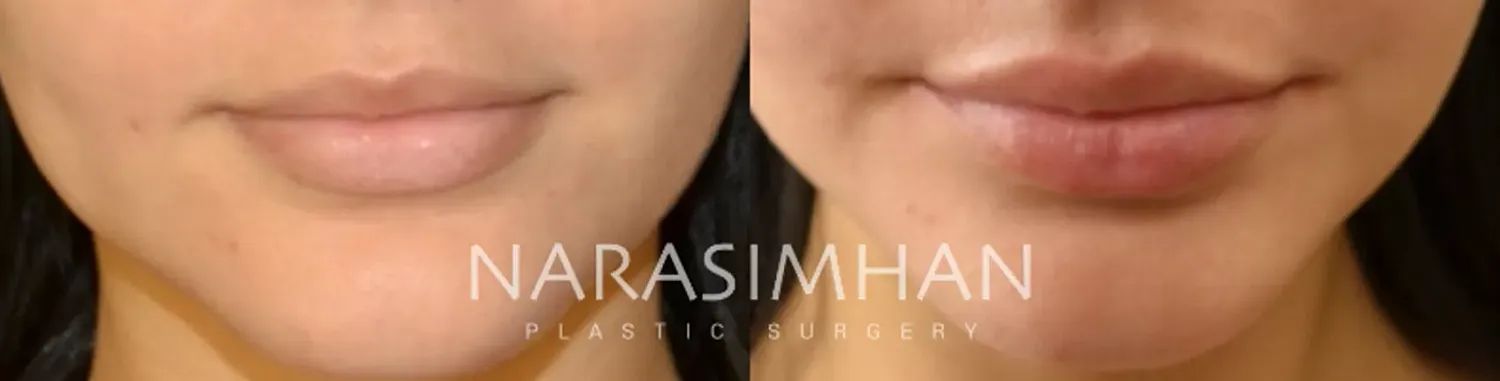 Lip Filler Before & After