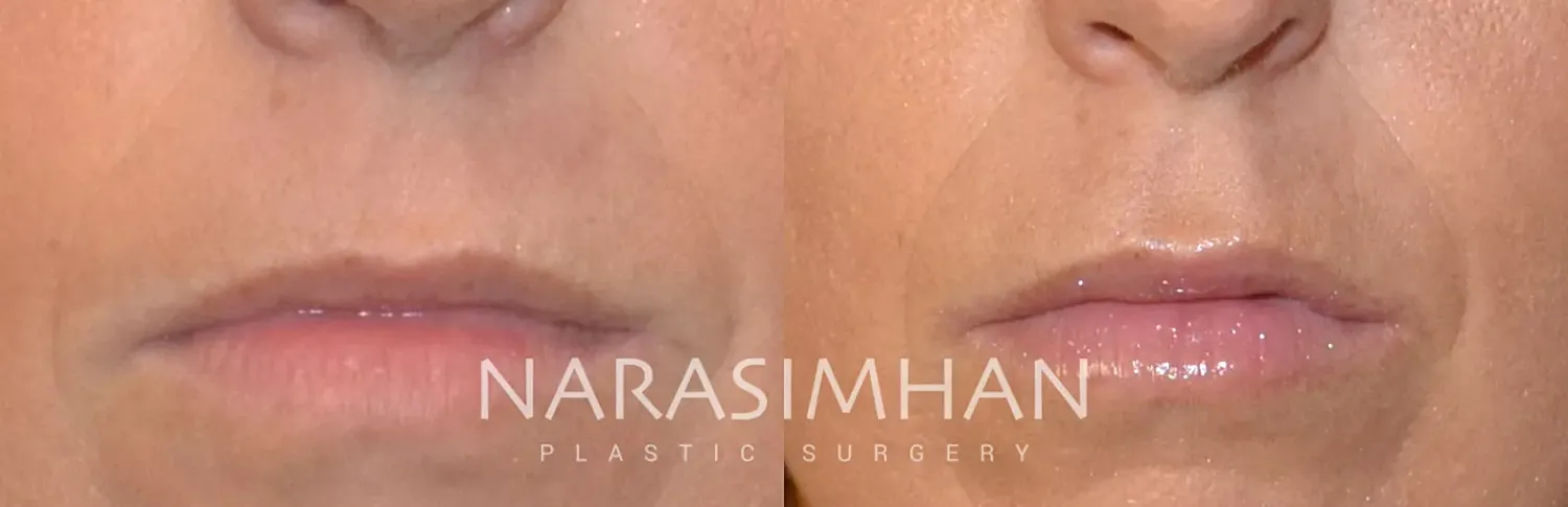 Lip Filler Before & After