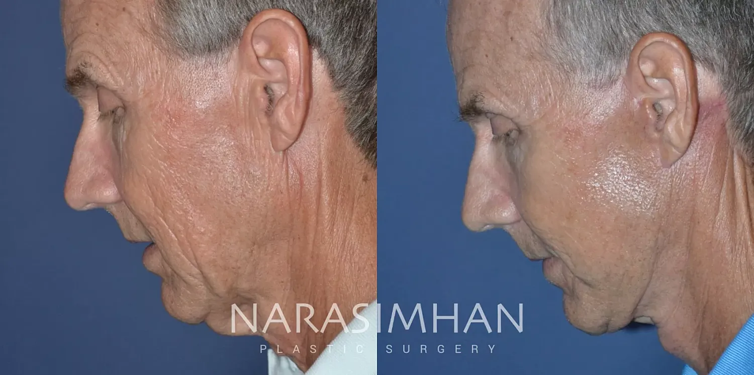 Male Facelift Before & After
