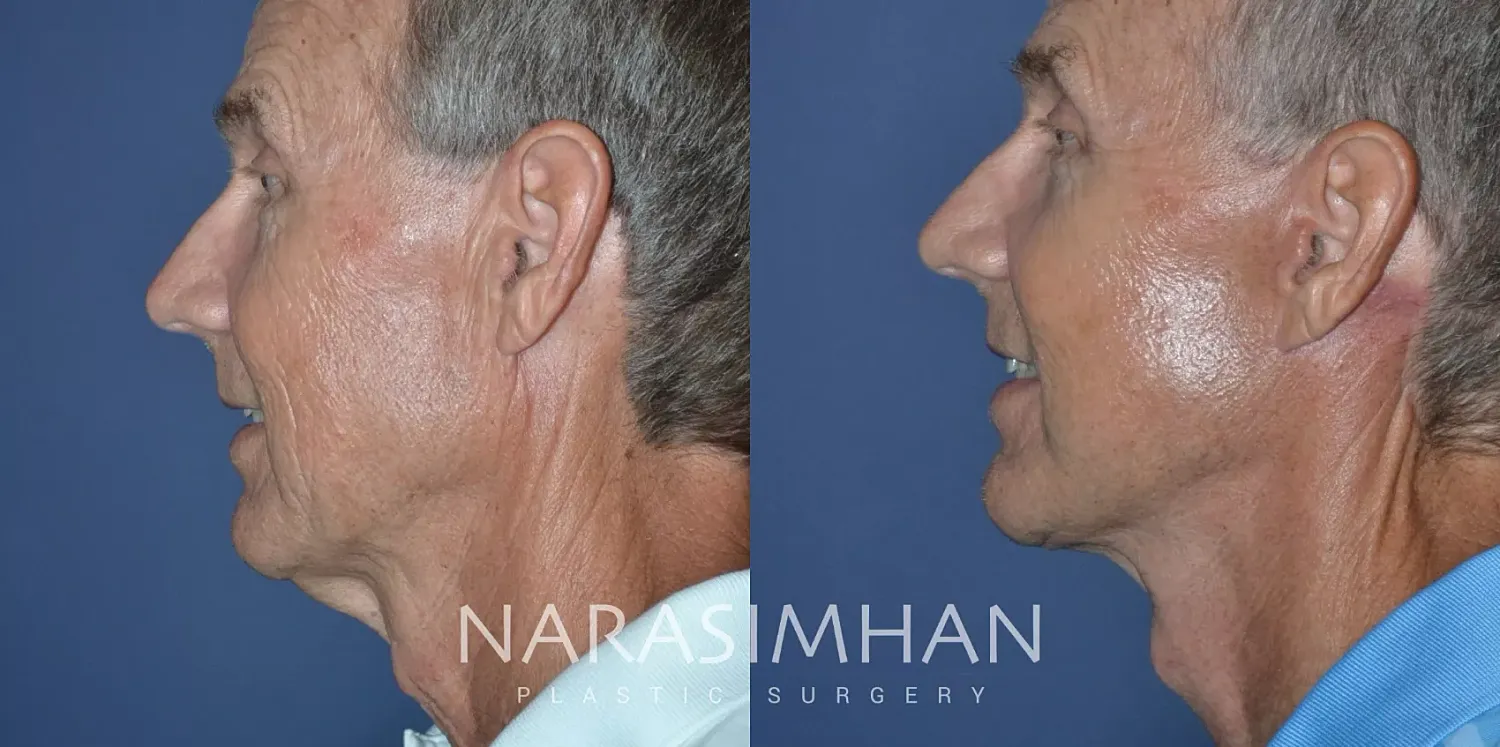 Male Facelift Before & After