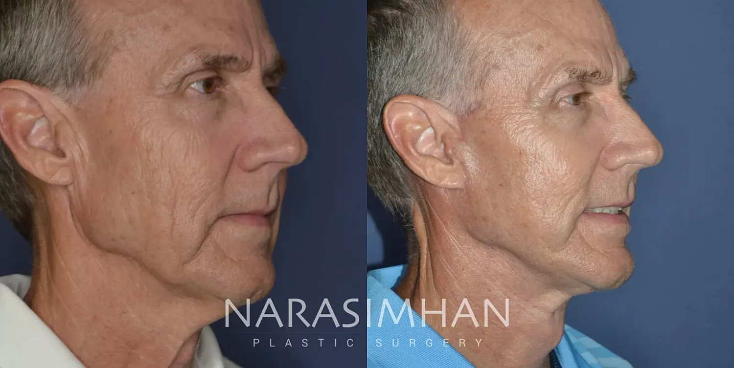Male Facelift Before & After