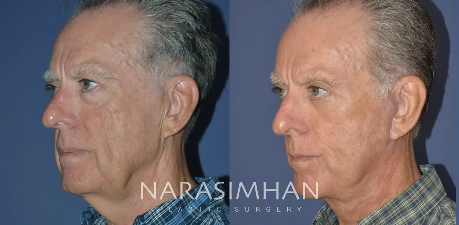 Male Facelift Before & After