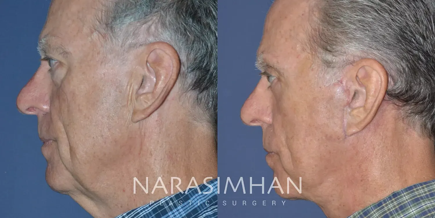 Male Facelift Before & After