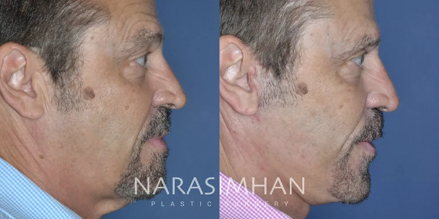Male Facelift Before & After